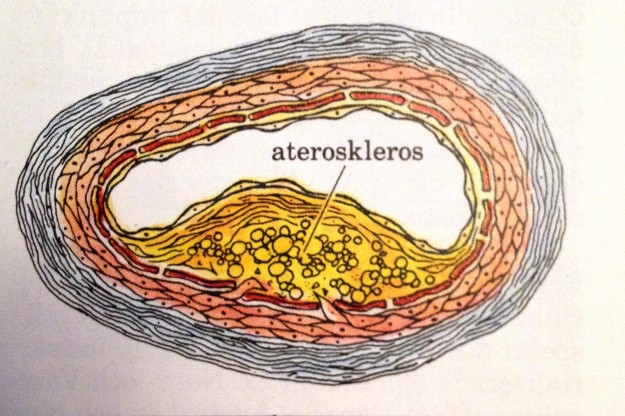 simvastatin motverkar ateroskleros